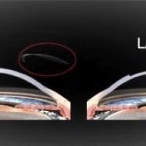 Prk e Lasik