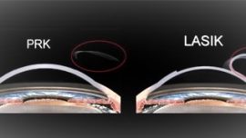 Prk e Lasik